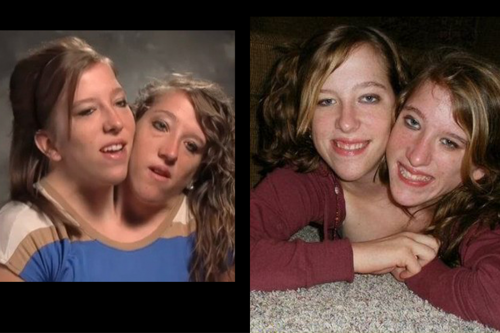 Abigail loraine hensel and brittany lee hensel (born march 7, 1990) are ame...
