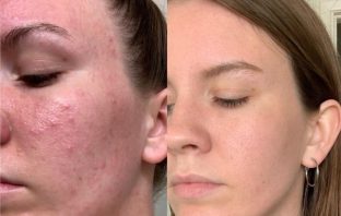 Get To Know More About The Causes Of Contact Dermatitis