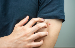 Here Are Five Ways To Stop Itching From Bug Bites