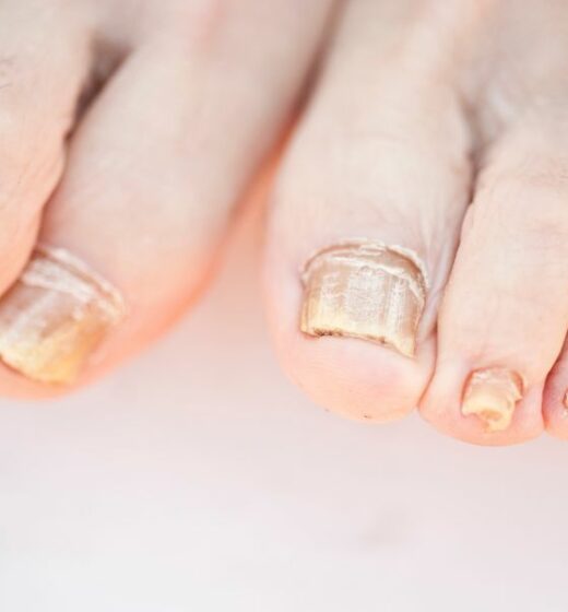 If Your Nails Keep Peeling, You Might Have a Deficiency