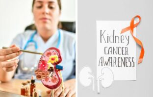Debunking Four Myths About Kidney Cancer