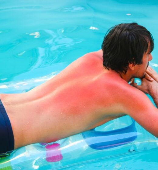 Sunburn: Five Tricks To Get Rid Of It