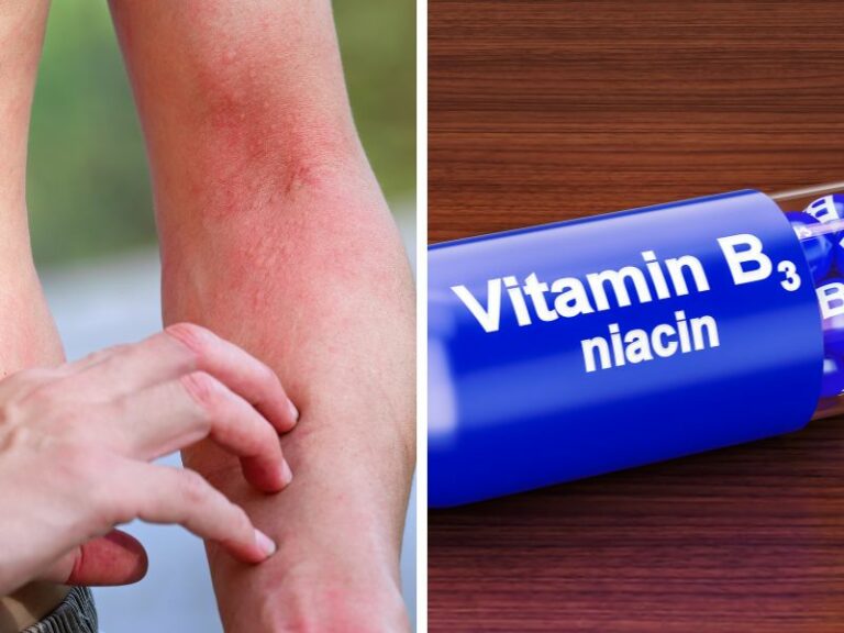 Symptoms And Signs Of Niacin Deficiency